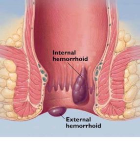 Internal and external hemorrhoids