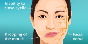 Bell’s Palsy and Eye Care